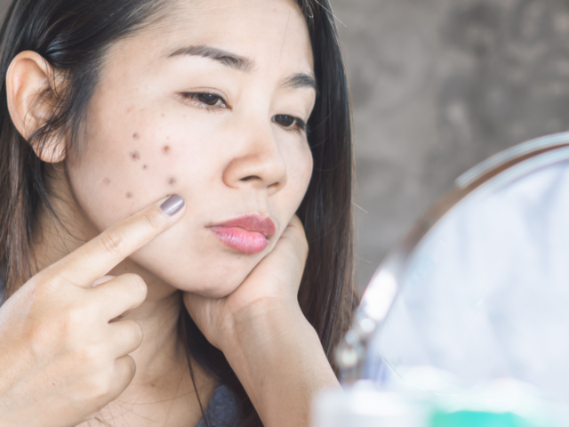 How to Address and Stop Dark Spots