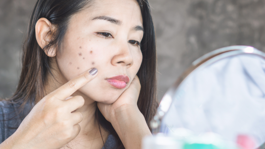 How to Address and Stop Dark Spots